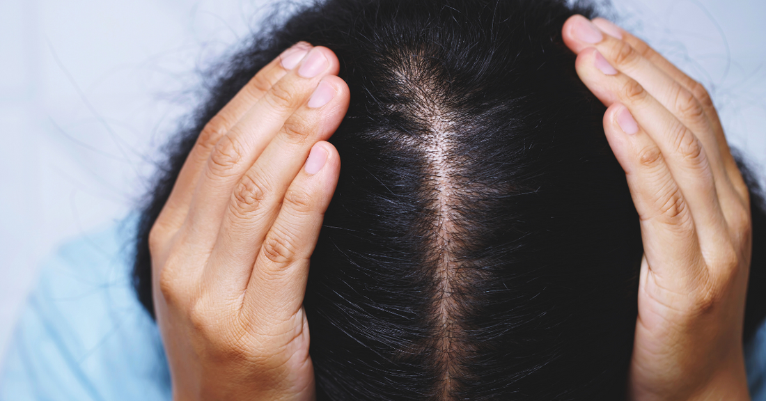 Close-up of Bangladeshi woman holding her scalp with visible hair thinning — highlighting the urgency of natural oil-based hair care solutions